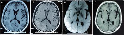 Prolonged Hemiplegic Migraine Led to Persistent Hyperperfusion and Cortical Necrosis: Case Report and Literature Review